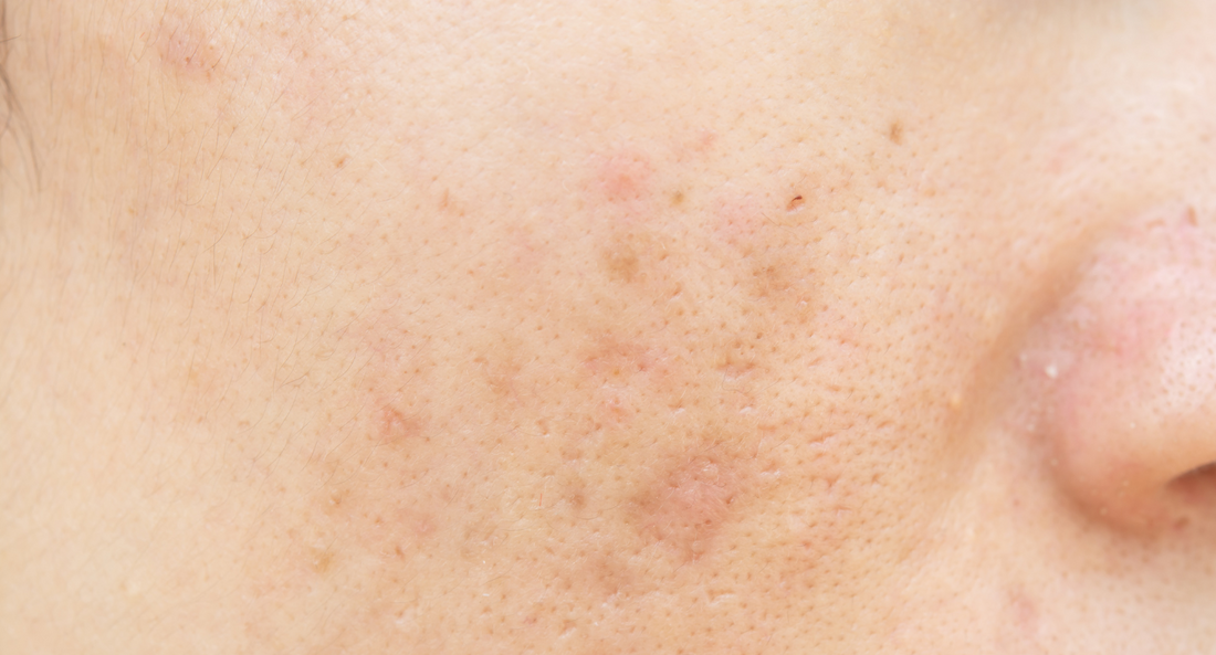 Pourquoi a-t-on plus de boutons en été ? Et comment les apaiser naturellement ?