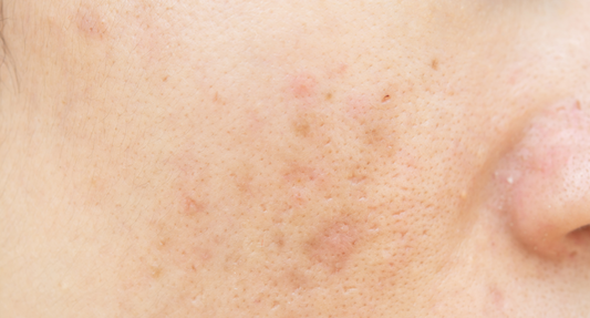 Pourquoi a-t-on plus de boutons en été ? Et comment les apaiser naturellement ?